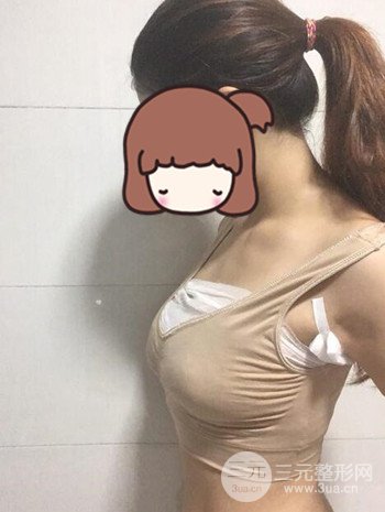 假體隆胸術(shù)后成功擺脫小學(xué)生身材，立現(xiàn)性感身材