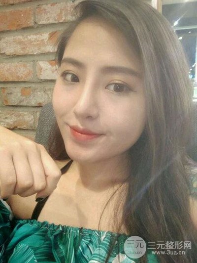 廣州美萊李高峰隆鼻整形案例前后對比圖分享~