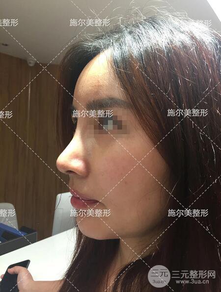 南京施爾美劉道功隆鼻案例術(shù)后恢復實記