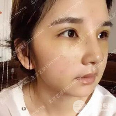 北京藝星隆鼻整形案例前后對(duì)比圖分享~
