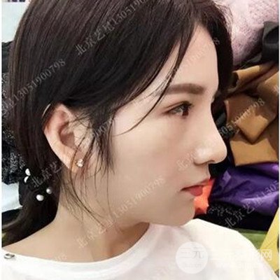 北京藝星隆鼻整形案例前后對(duì)比圖分享~