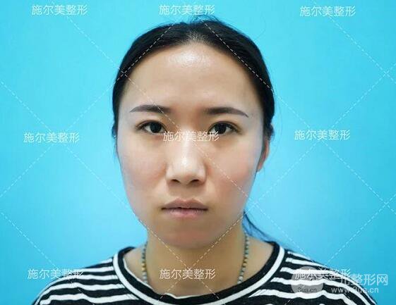 南京施爾美玻尿酸注射案例,讓蘋果肌嘭嘭嘭！