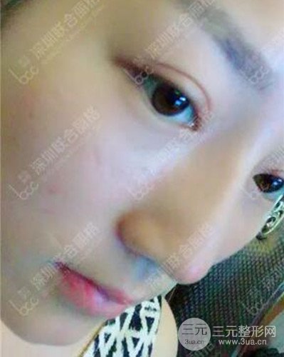 深圳聯(lián)合麗格線D隆鼻恢復(fù)日記以及前后對(duì)比圖分享！