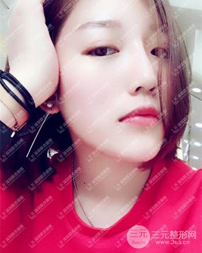 深圳聯(lián)合麗格線D隆鼻恢復(fù)日記以及前后對(duì)比圖分享！