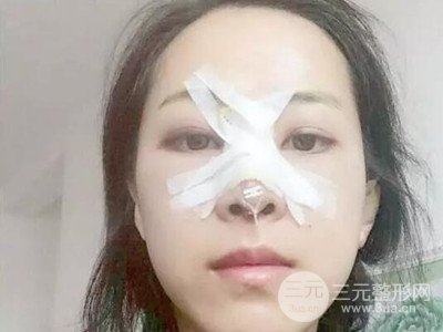 長沙鵬愛彭正春假體隆鼻案例分享