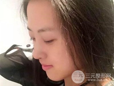 長沙鵬愛彭正春假體隆鼻案例分享