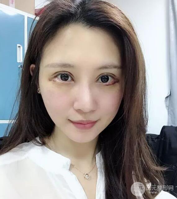 蘭大二院張選奮怎么樣?雙眼皮修復案例前后對比圖