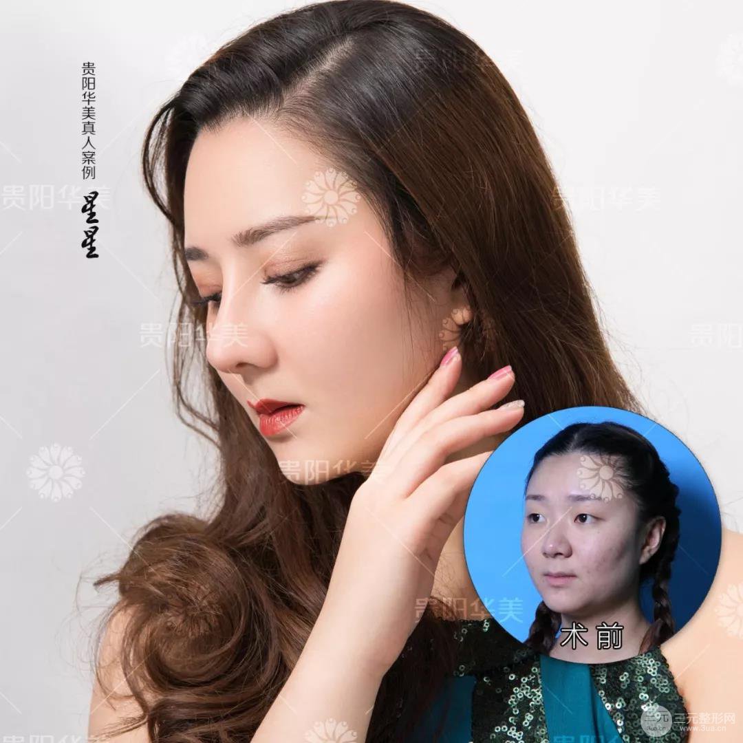 貴陽(yáng)華美牛勇敢全切雙眼皮+假體隆鼻案例前后對(duì)比圖 華美員工全臉整形實(shí)錄