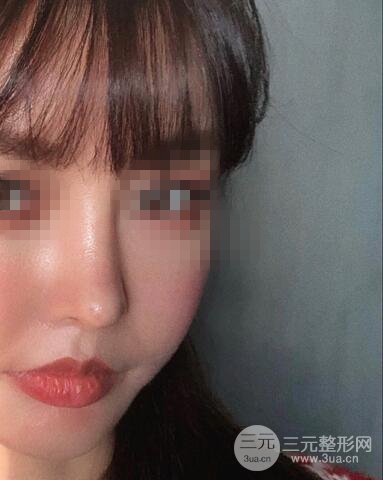 揚州艾菲斯整形隆鼻案例，自拍盛顏不是夢！