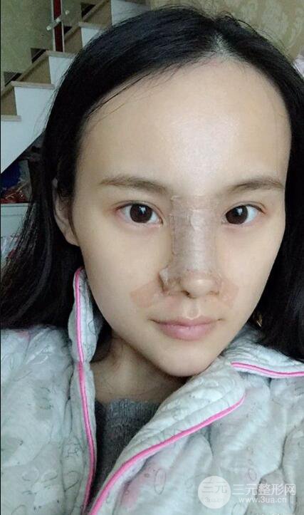 成都大華隆鼻怎么樣?真實(shí)案例前后對比圖記錄恢復(fù)過程