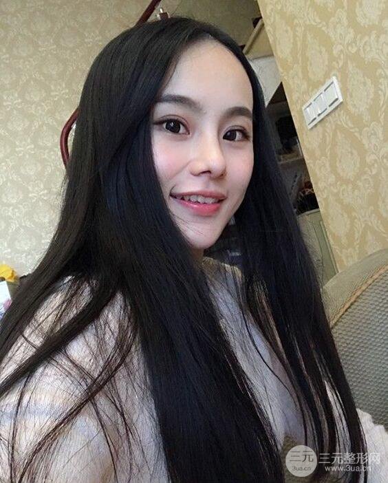 成都大華隆鼻怎么樣?真實(shí)案例前后對比圖記錄恢復(fù)過程