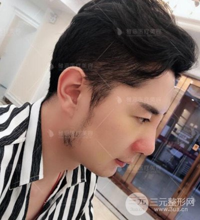 肋軟骨隆鼻整形案例分享，在深圳雅涵做的!