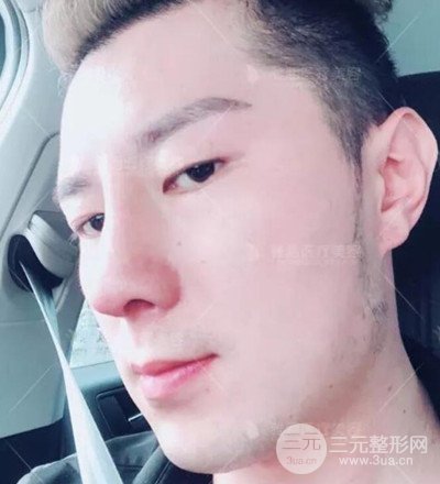 肋軟骨隆鼻整形案例分享，在深圳雅涵做的!