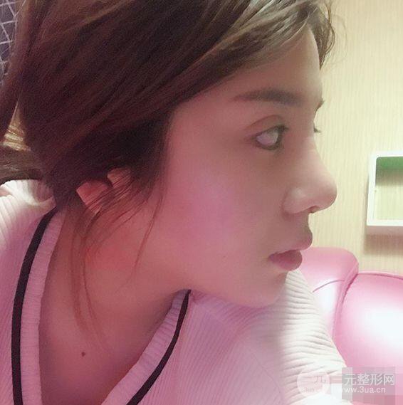 昆明吳氏嘉美李明硅膠隆鼻前后對(duì)比圖恢復(fù)心情小札