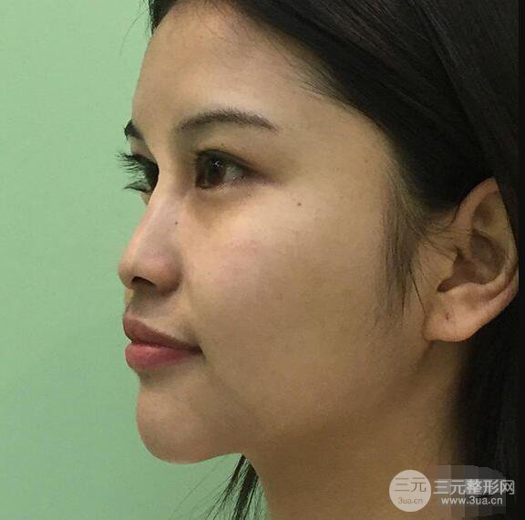 成都華西醫(yī)院整形美容科卿勇隆鼻整形前后對比圖恢復(fù)心情小札