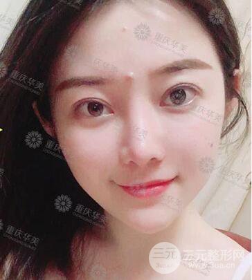 重慶華美何春濤假體隆鼻案例過(guò)程恢復(fù)分享