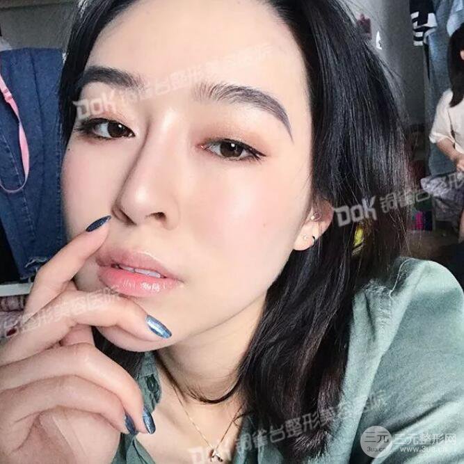 重慶銅雀臺假體隆鼻前后對比圖案例分享!