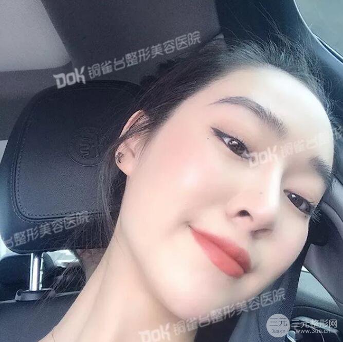重慶銅雀臺假體隆鼻前后對比圖案例分享!