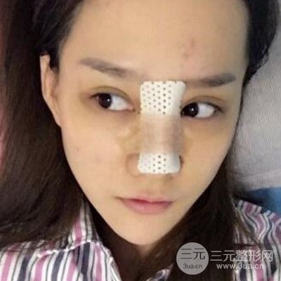 廣州韓妃李光琴隆鼻失敗修復(fù)前后對(duì)比圖分享！