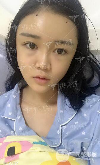 北京玉之光自體脂肪面部填充案例