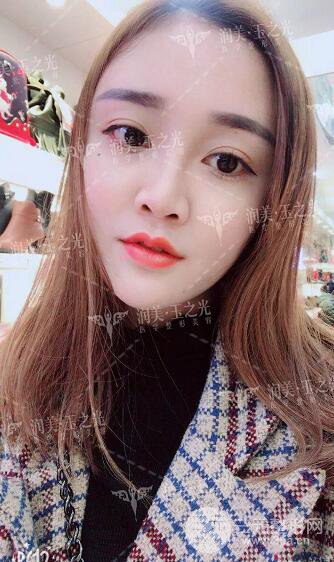 北京玉之光自體脂肪面部填充案例