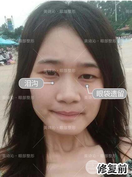 北京詩(shī)美沁祛眼袋案例術(shù)后果分享！