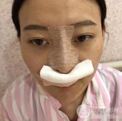 南京華美隆鼻整形前后對(duì)比圖分享