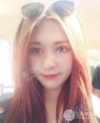 青島伊美爾5s雙眼皮案例術(shù)后恢復(fù)果圖記錄