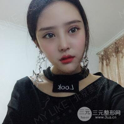 北京美萊趙峻賢隆鼻整形真實(shí)案例對(duì)比圖恢復(fù)過程分享