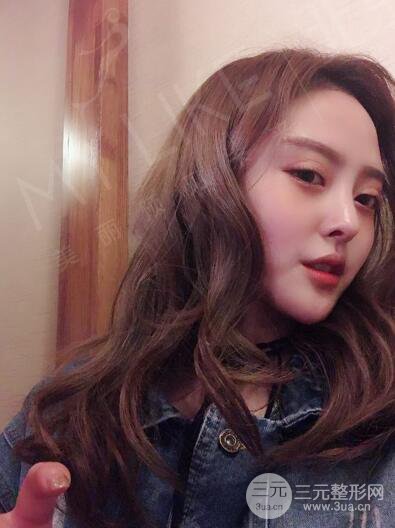 北京美萊趙峻賢隆鼻整形真實(shí)案例對(duì)比圖恢復(fù)過程分享