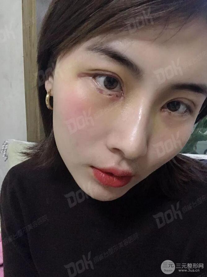 成都銅雀臺切開雙眼皮-45°原生開內(nèi)眼角案例分享~