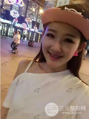 沈陽杏林史靈芝醫(yī)生隆鼻整形案例日記分享~