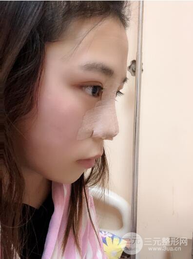 貴陽(yáng)麗都李觀龍隆鼻整形案例對(duì)照?qǐng)D一個(gè)月恢復(fù)過(guò)程分享