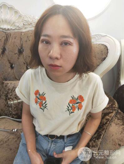 湘潭華美切開雙眼皮案例對(duì)照?qǐng)D兩個(gè)月恢復(fù)過(guò)程心情日扎