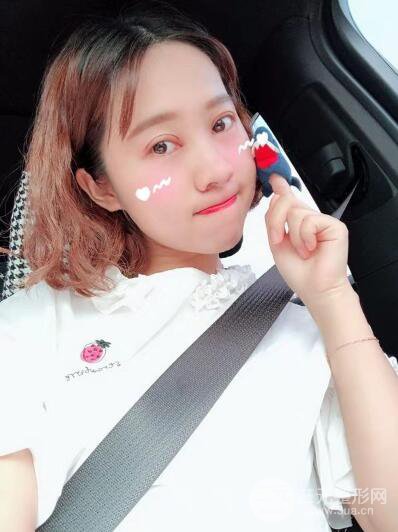 湘潭華美切開雙眼皮案例對(duì)照?qǐng)D兩個(gè)月恢復(fù)過(guò)程心情日扎