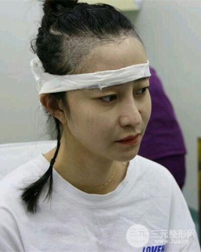 北京雍禾韓巖發(fā)際線種植手術(shù)半年了，分享前后果圖片~