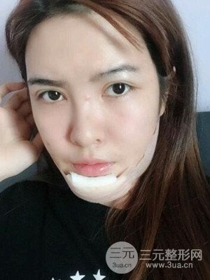 廣州廣美硅膠墊下巴恢復(fù)過程|前后對(duì)比照分享