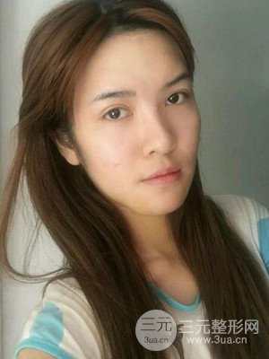 廣州廣美硅膠墊下巴恢復(fù)過程|前后對(duì)比照分享