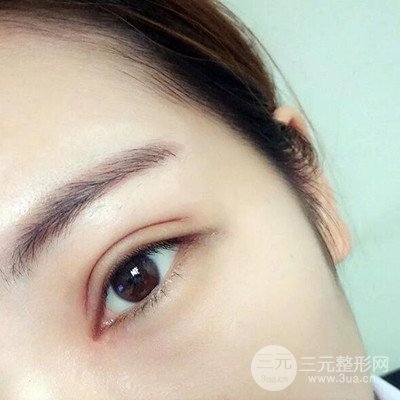 成都素美楊迪雙眼皮案例前后對(duì)比照分享~