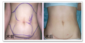 吸脂瘦身之脂肪抽吸整形 詳細吸脂塑身