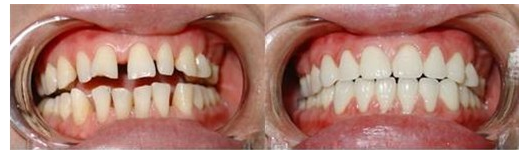 四川做美容冠的使用壽命是多久