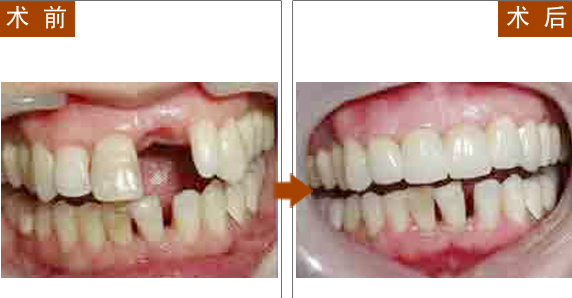 四川做美容冠矯正牙齒的材料有哪些