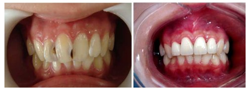 四川做烤瓷牙的價(jià)格貴嗎