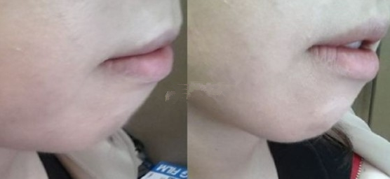 隆下巴后氣質(zhì)多了