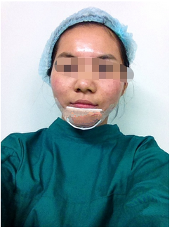 假體墊下巴，果很不錯(cuò)哦