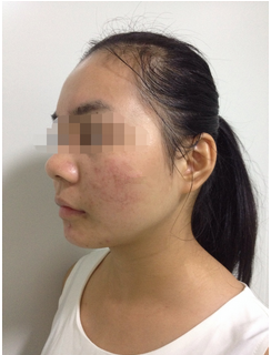 假體墊下巴，果很不錯(cuò)哦