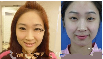 雙眼皮手術后更漂亮了