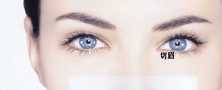 切眉術(shù)有哪些注意事項(xiàng) 切眉術(shù)前后對(duì)比圖