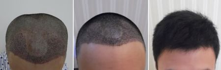 植發(fā)大約多少錢 植發(fā)手術果圖