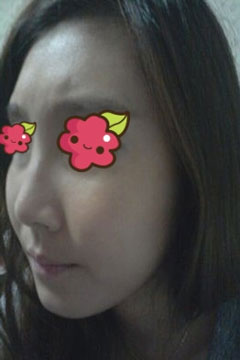 非手術(shù)隆鼻費用一般需要多少錢,非手術(shù)隆鼻前的注意事項